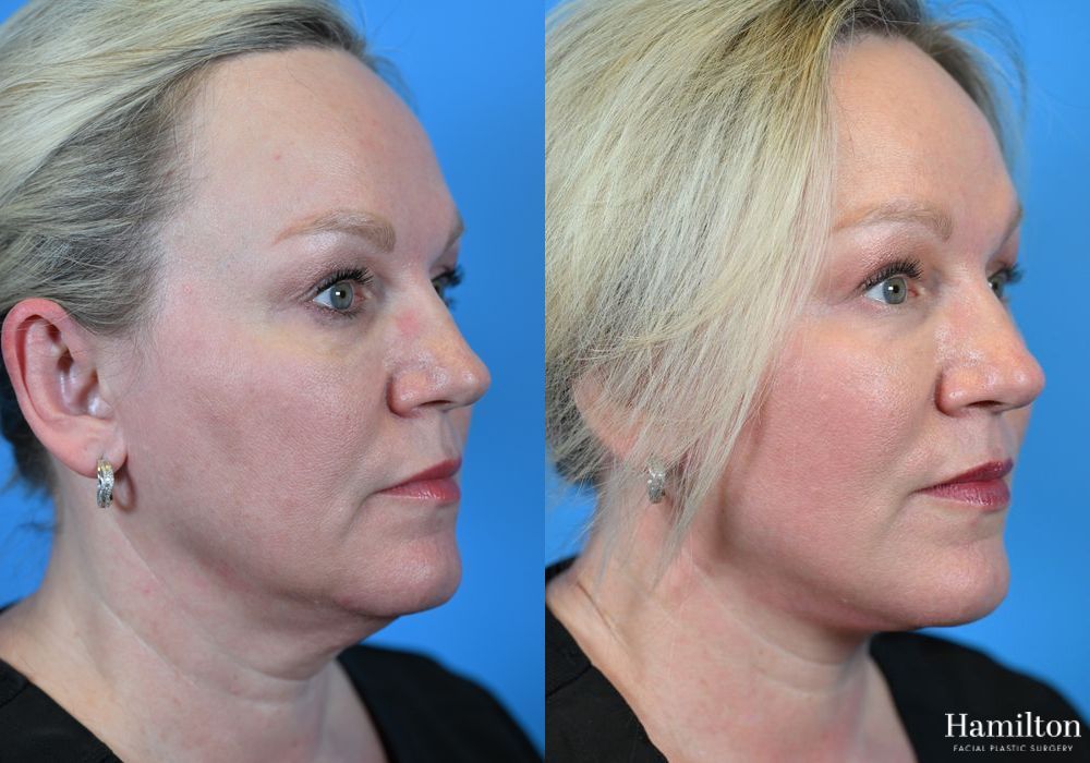 Before and after Facelift case 37317 - Angle 2