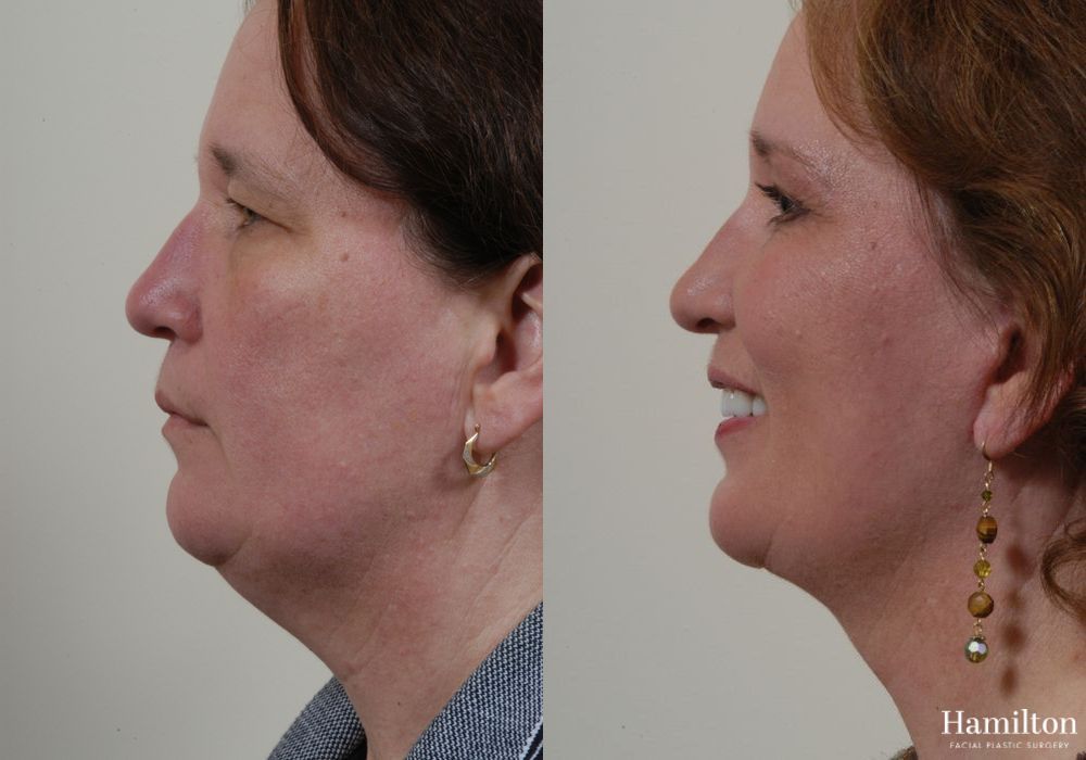 Before and after Facelift case 37265
