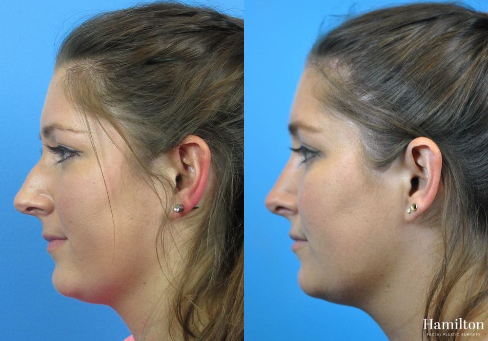 Before and after Rhinoplasty case 37313