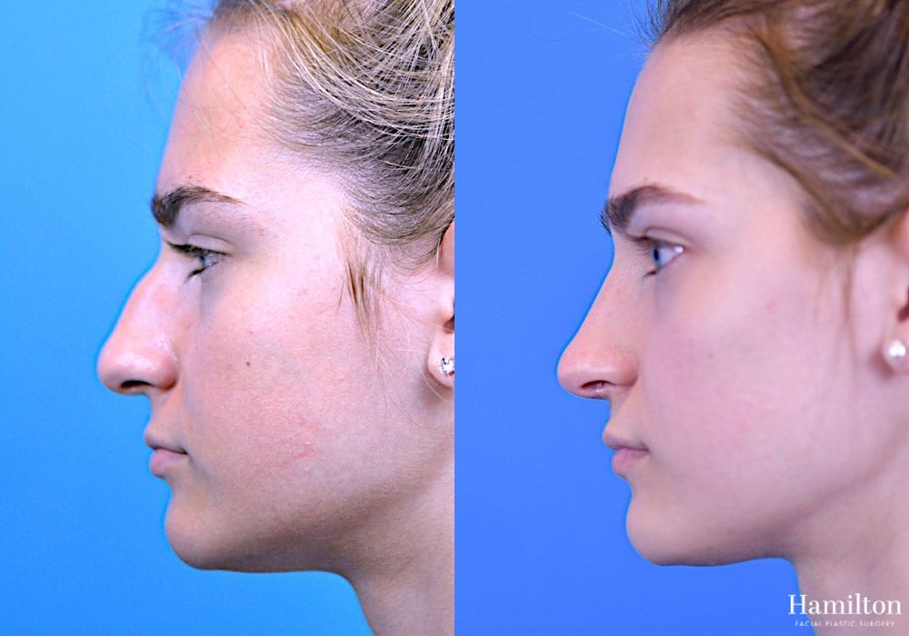 Before and after Rhinoplasty case 37251 - Angle 3