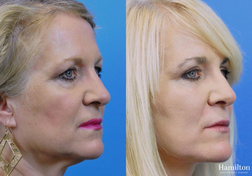 Before and after Facelift case 37266