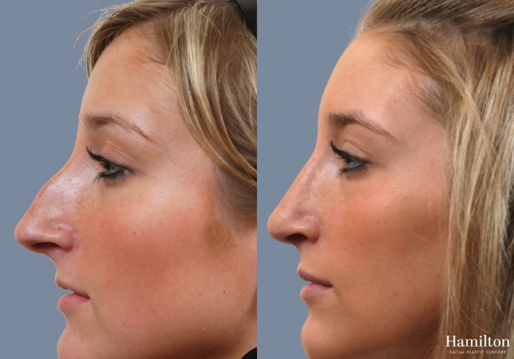 Before and after Rhinoplasty case 37211