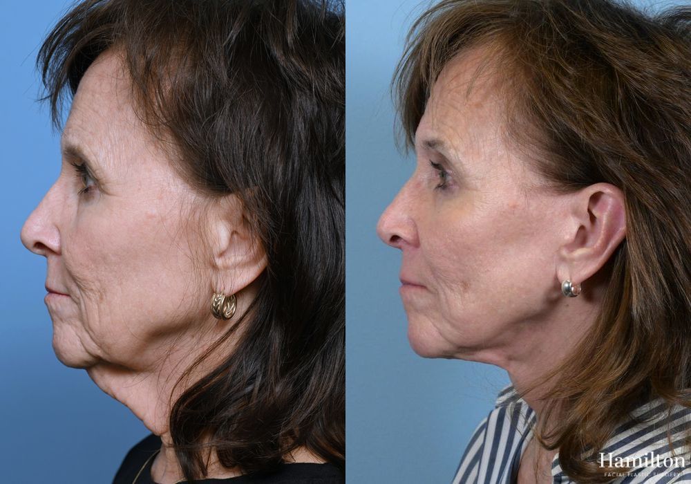 Before and after Facelift case 37338 - Angle 2