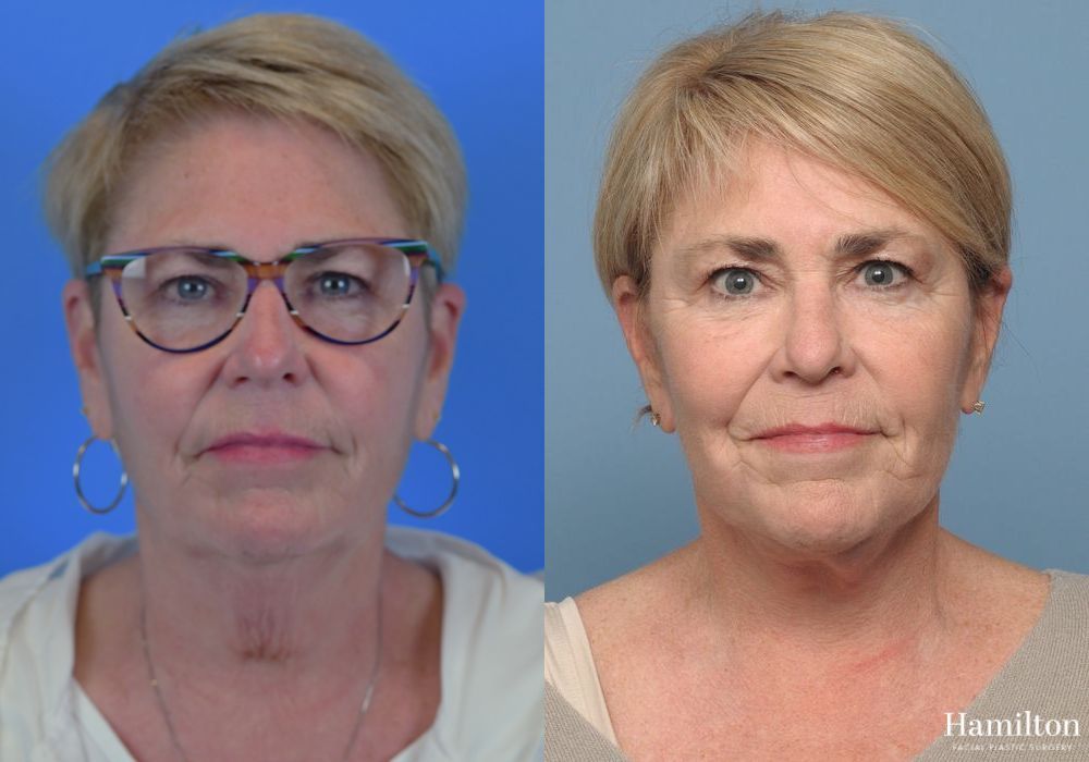 Before and after Facelift case 37290 - Angle 4