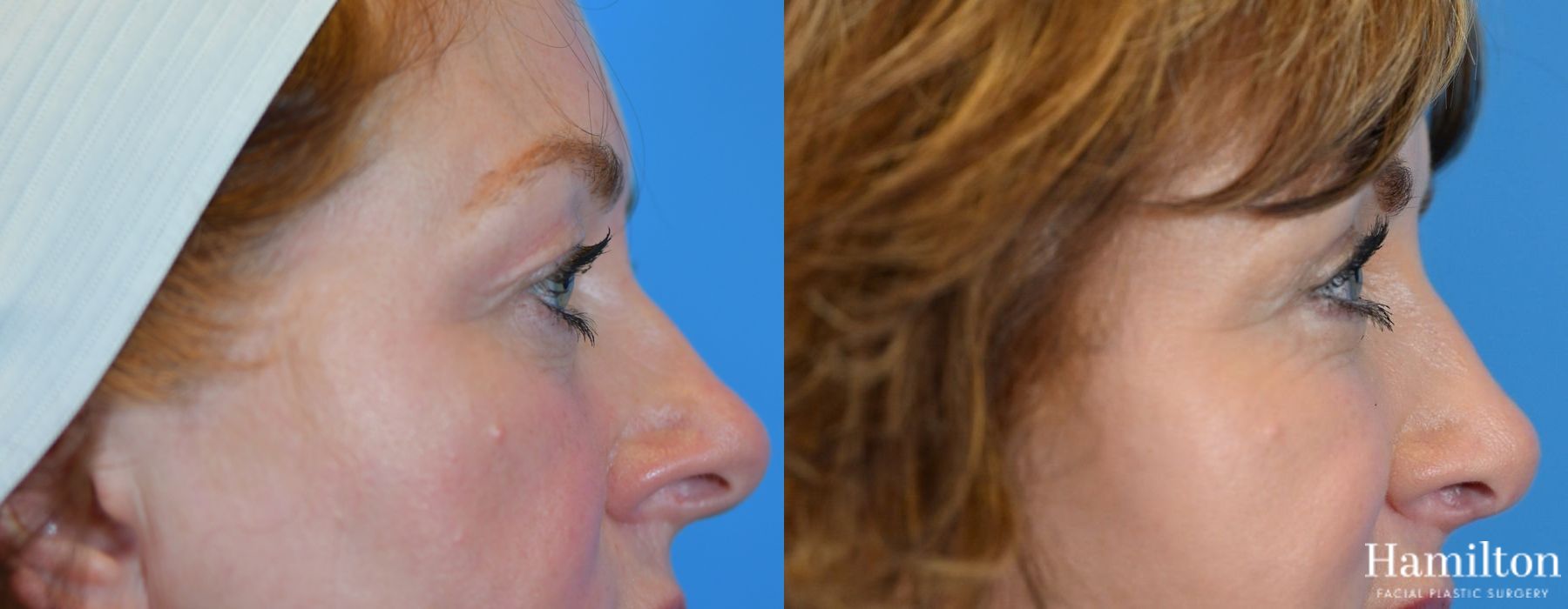 Before and after Blepharoplasty case 37277 - Angle 5