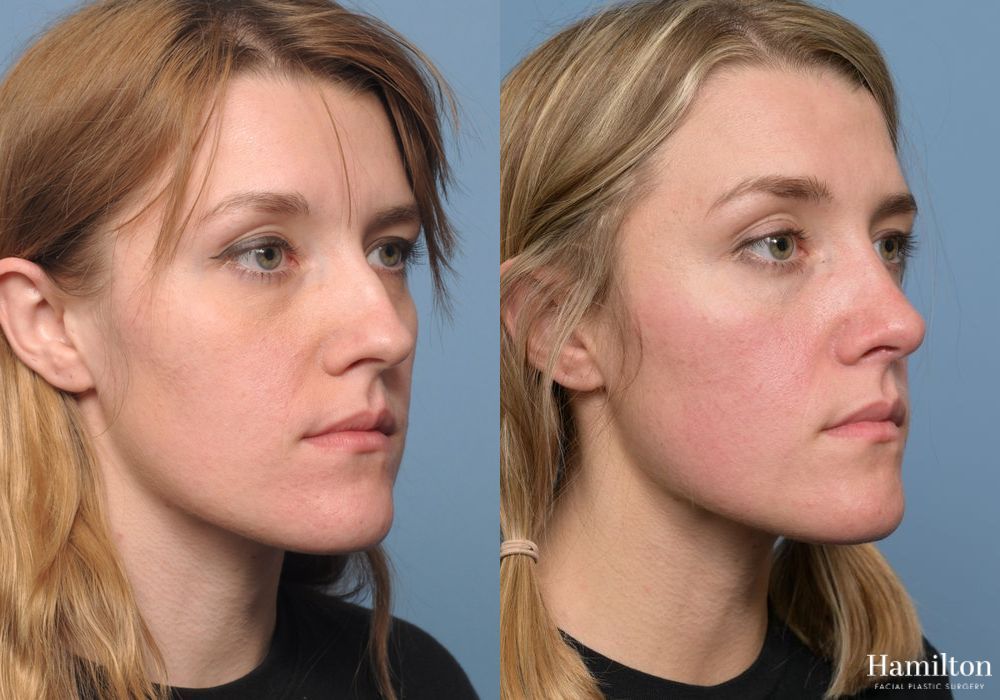 Before and after Rhinoplasty case 37136 - Angle 3