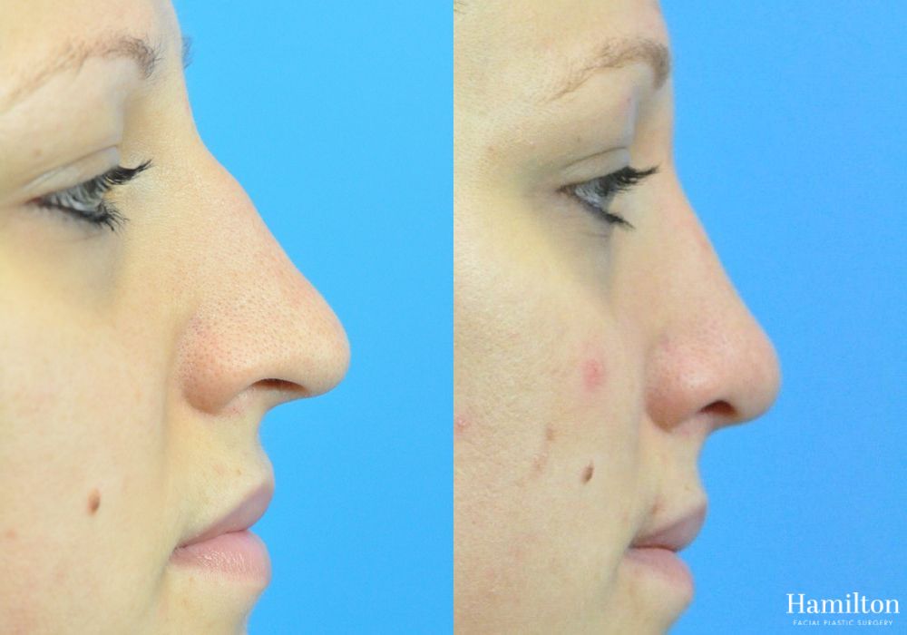 Before and after Rhinoplasty case 37357 - Angle 4