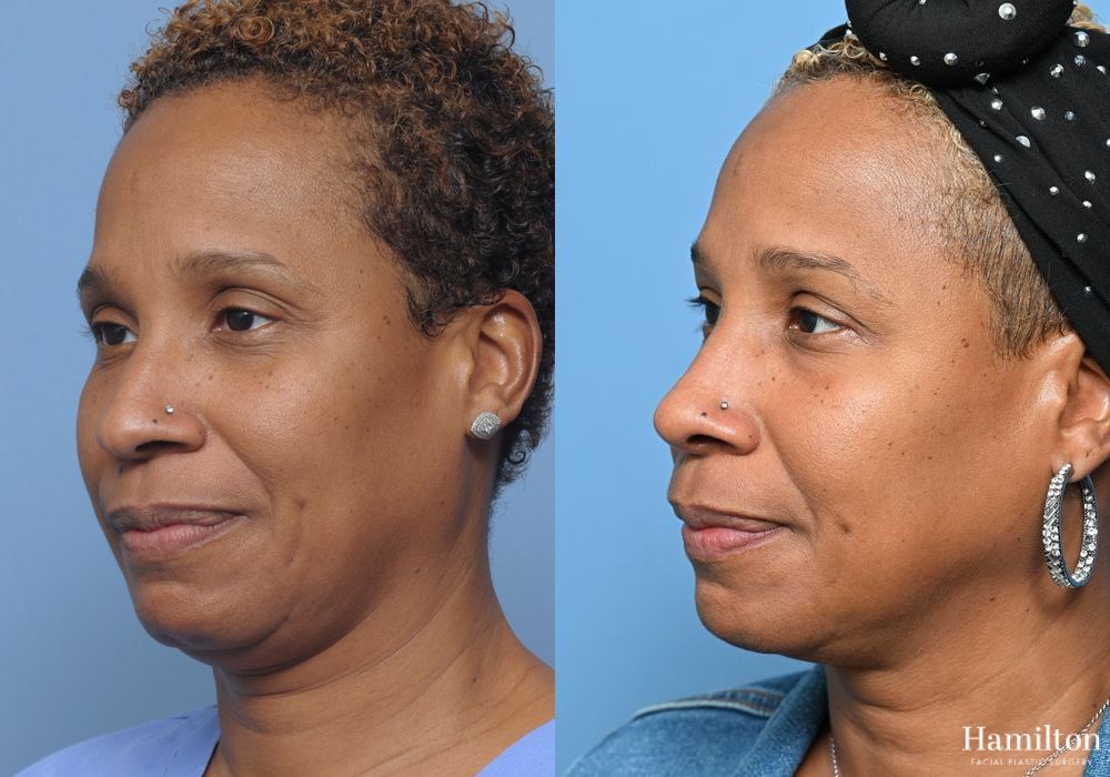 Before and after Rhinoplasty case 37298 - Angle 4