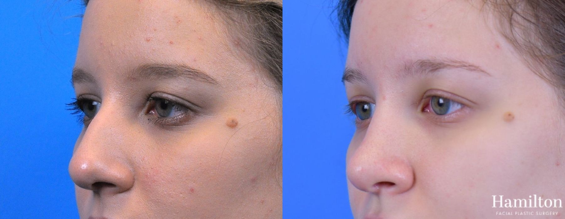 Before and after Rhinoplasty case 37269 - Angle 4