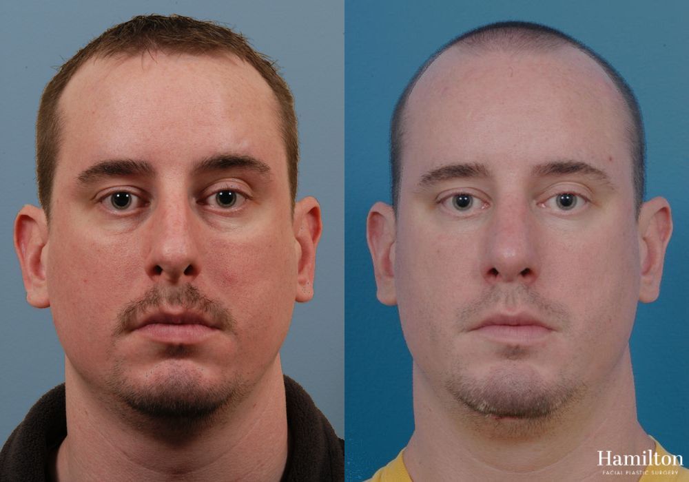 Before and after Chin Augmentation case 37207 - Angle 2