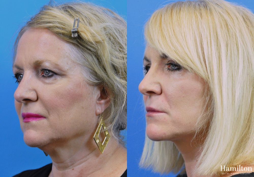 Before and after Facelift case 37266 - Angle 2
