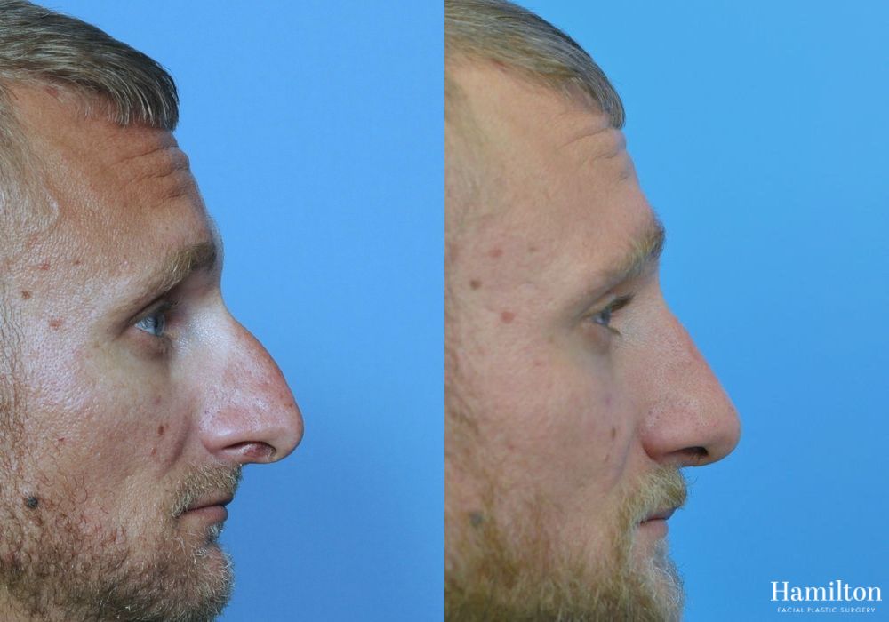 Before and after Rhinoplasty case 37303 - Angle 3