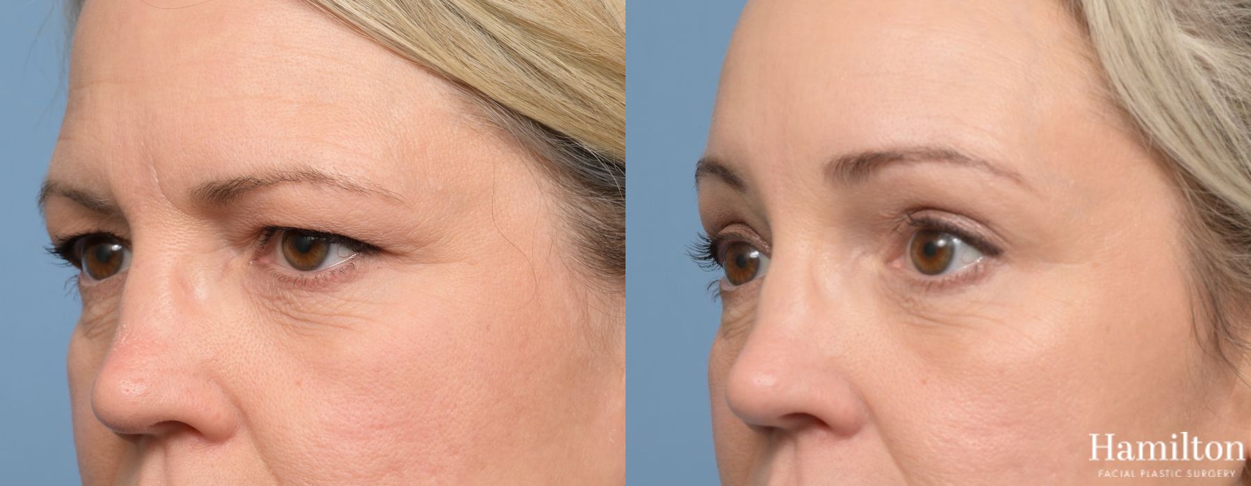 Before and after Blepharoplasty case 37175