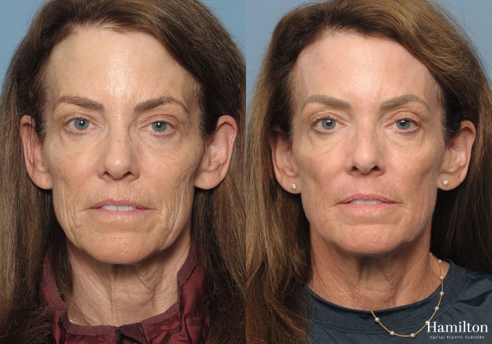 Before and after Laser - CO2 case 37150