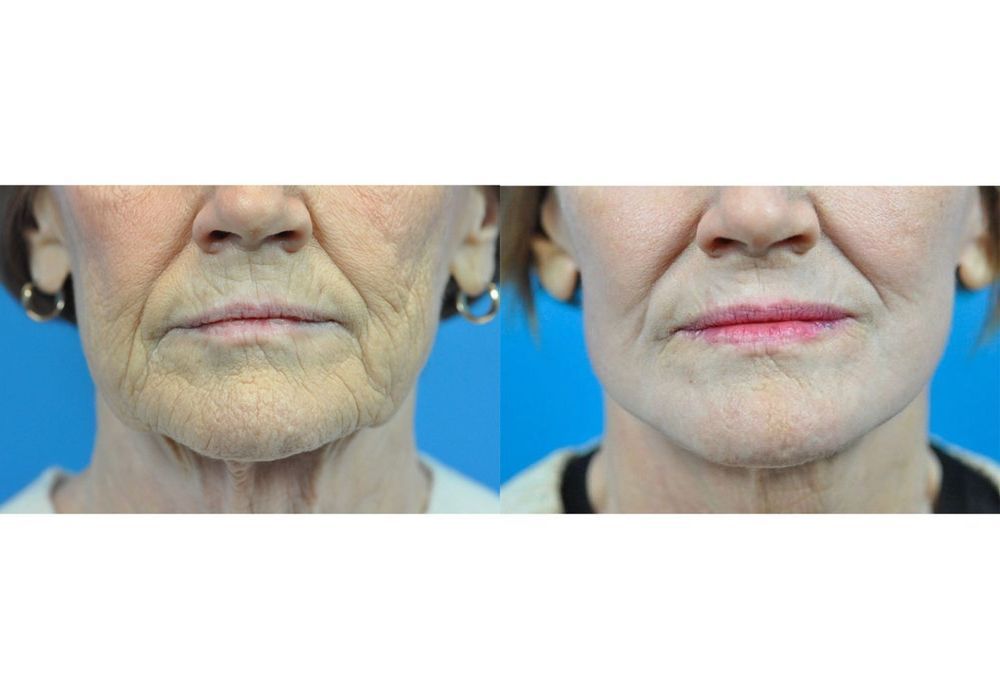Before and after Facelift case 37320 - Angle 3