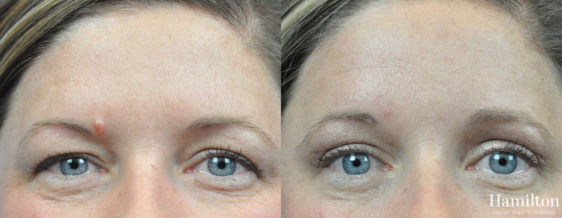 Before and after Blepharoplasty case 37307