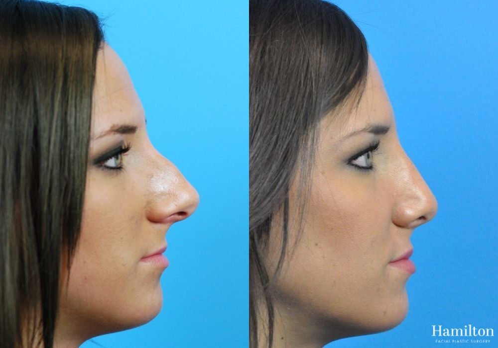 Before and after Rhinoplasty case 37287