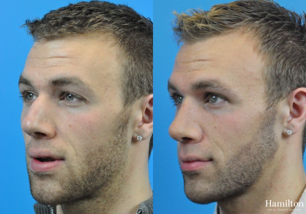 Before and after Rhinoplasty case 37250 - Angle 4