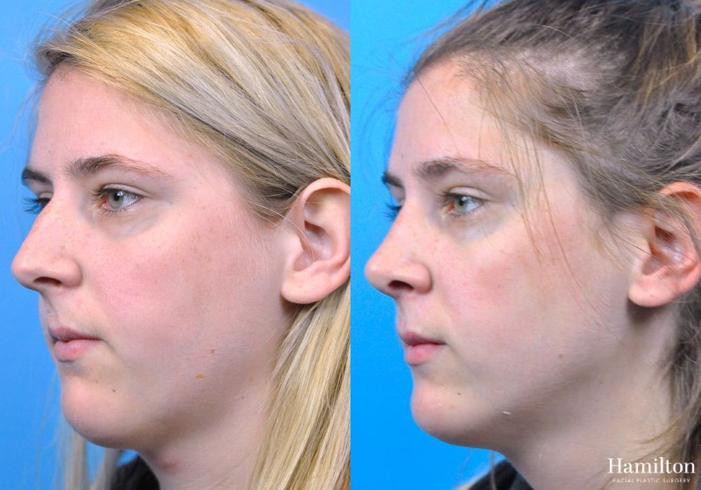 Before and after Rhinoplasty case 37354 - Angle 2