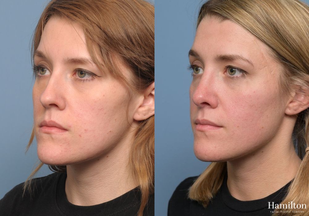 Before and after Rhinoplasty case 37136 - Angle 5