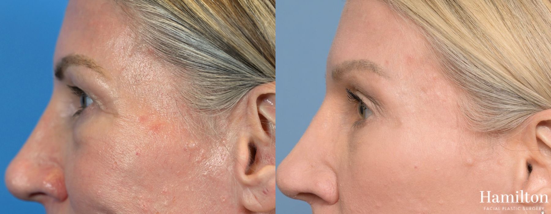 Before and after Blepharoplasty case 37257 - Angle 3