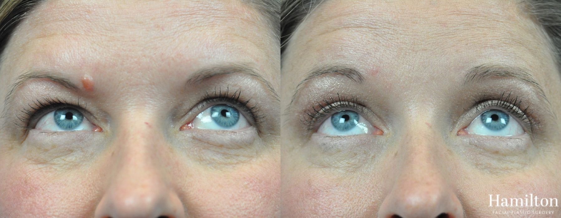 Before and after Blepharoplasty case 37307 - Angle 2