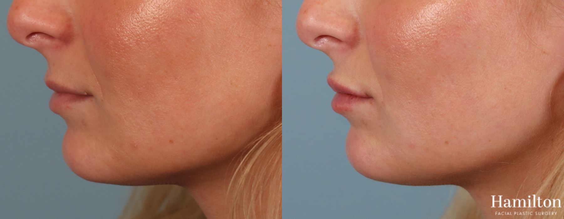 Before and after Lip Enhancement case 37173 - Angle 4
