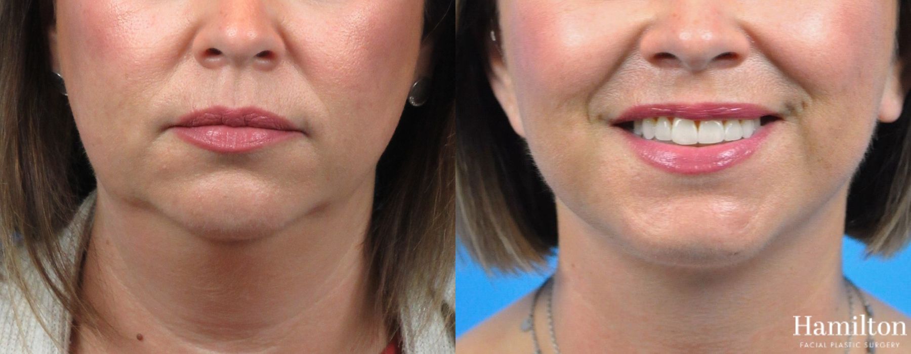 Before and after Neck Rejuvenation case 37187 - Angle 2