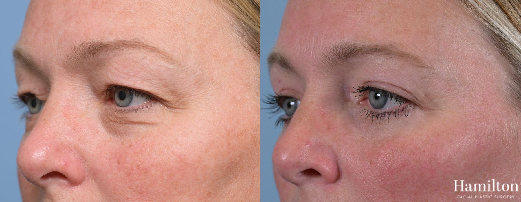 Before and after Blepharoplasty case 37119 - Angle 5