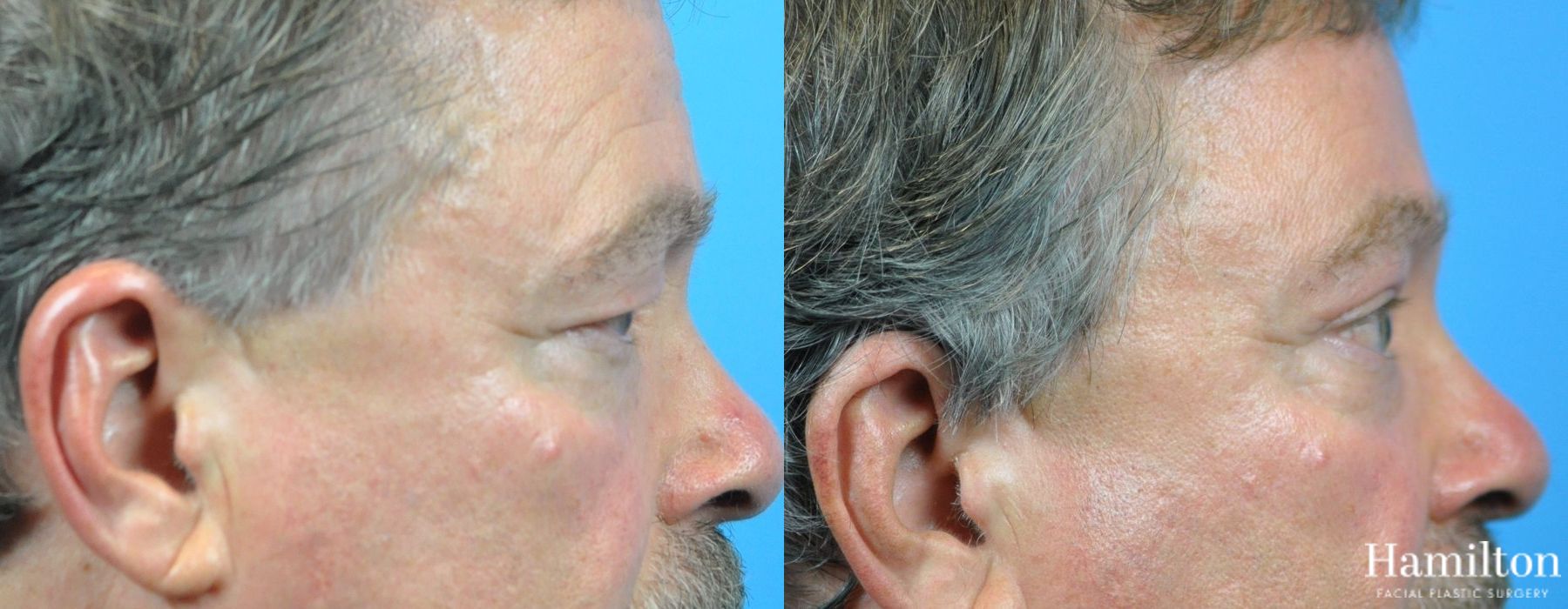 Before and after Blepharoplasty case 37319 - Angle 5