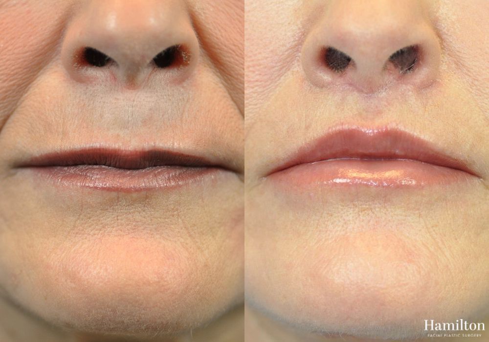 Before and after Lip Lift case 37122