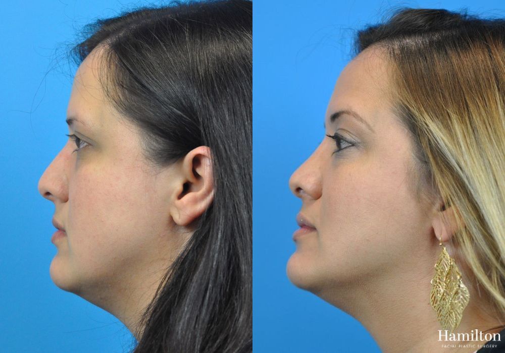 Before and after Rhinoplasty case 37327 - Angle 3
