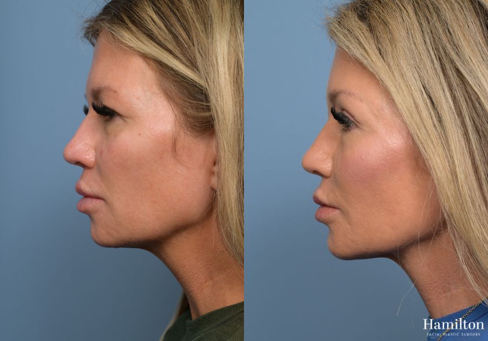 Before and after Brow Lift case 37111 - Angle 5