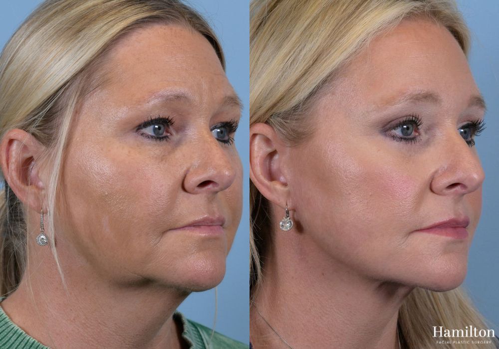 Before and after Brow Lift case 37178 - Angle 5