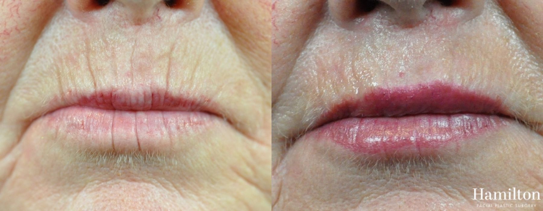 Before and after Lip Enhancement case 37242 - Angle 2