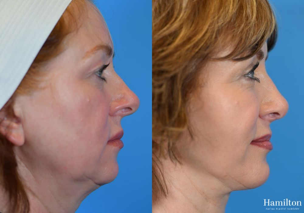 Before and after Rhinoplasty case 37318 - Angle 4