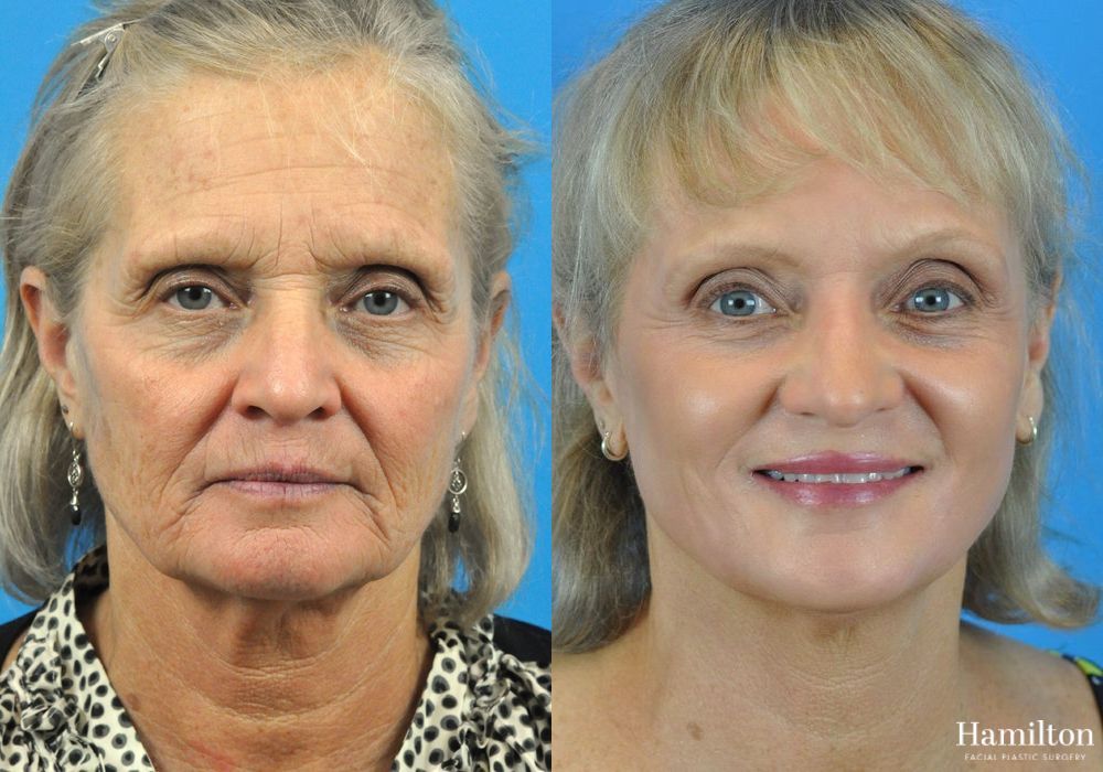 Before and after Laser - CO2 case 37091