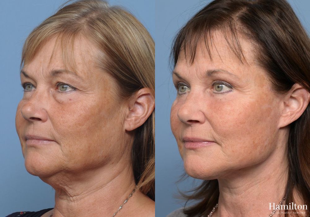 Before and after Facelift case 37258 - Angle 2