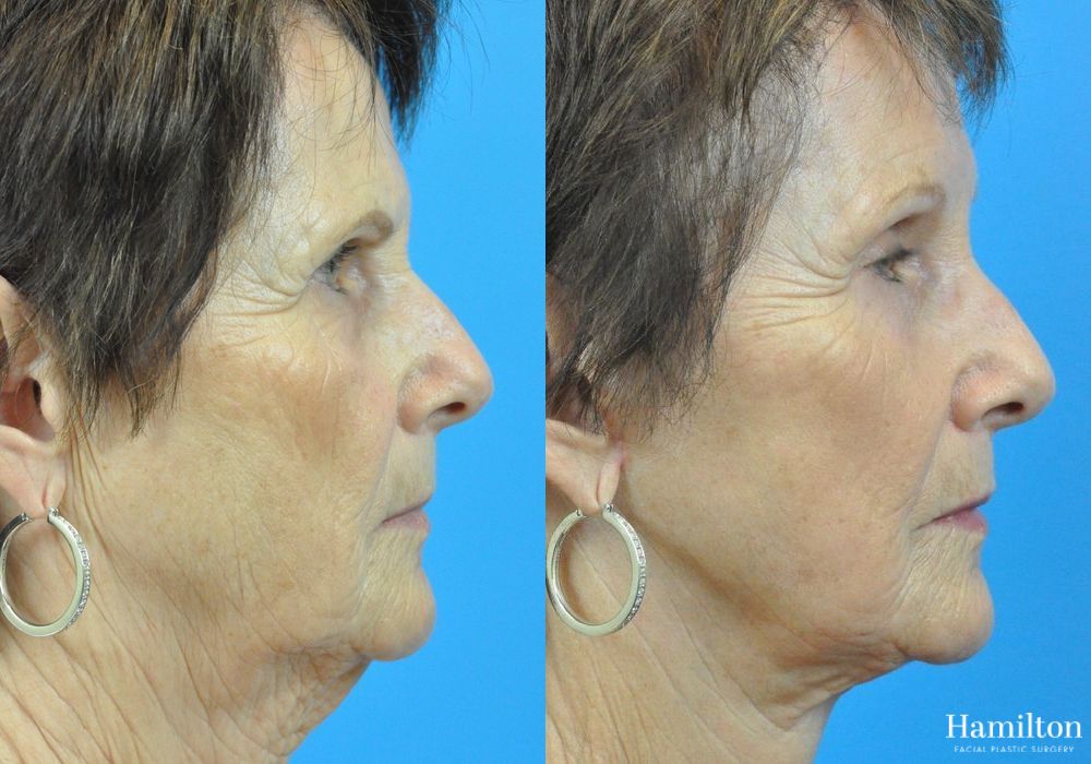 Before and after Neck Rejuvenation case 37223 - Angle 2
