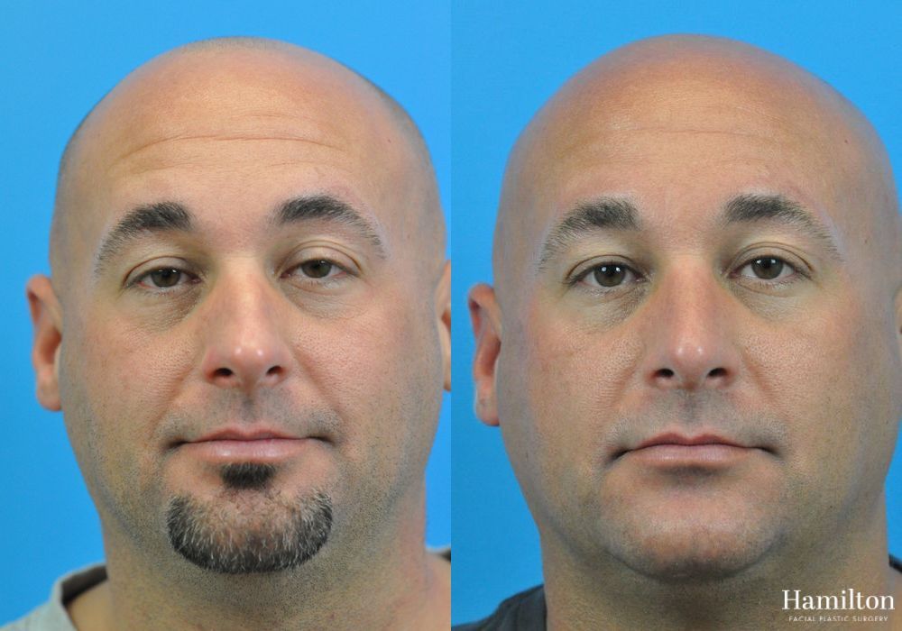 Before and after Rhinoplasty case 37255 - Angle 5