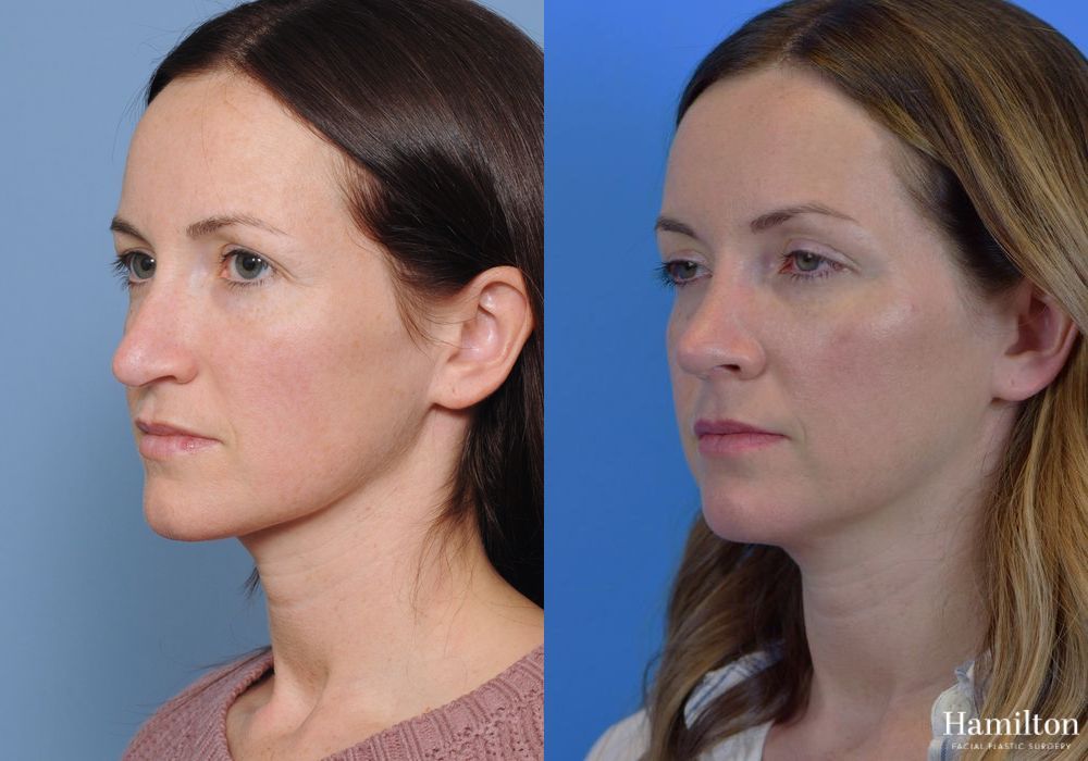 Before and after Rhinoplasty case 37199 - Angle 6