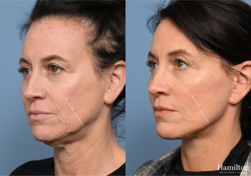Before and after Fat Grafting case 37115