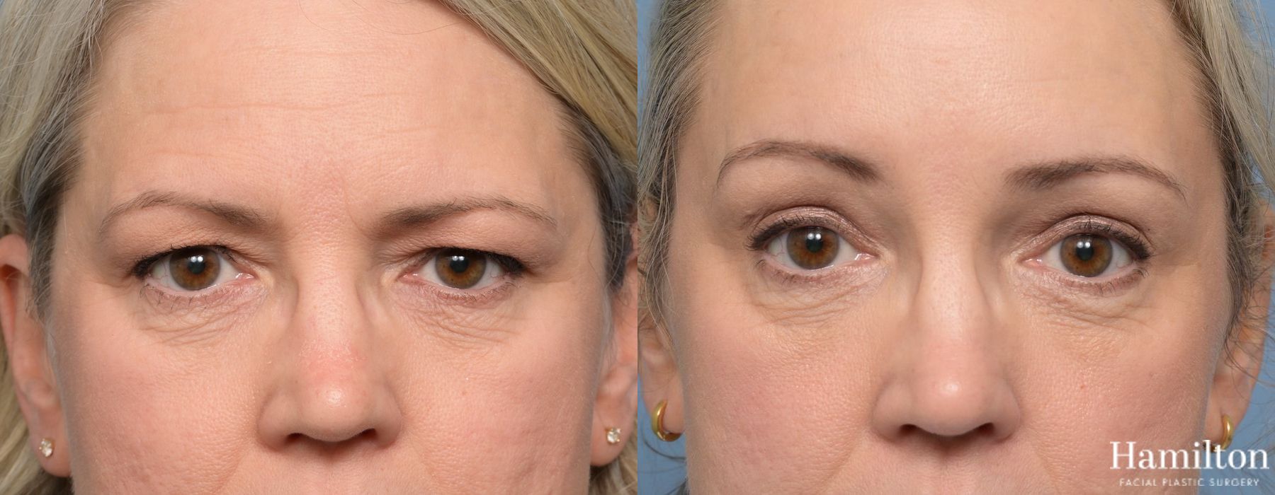 Before and after Blepharoplasty case 37175 - Angle 4