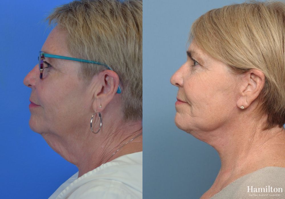 Before and after Facelift case 37290