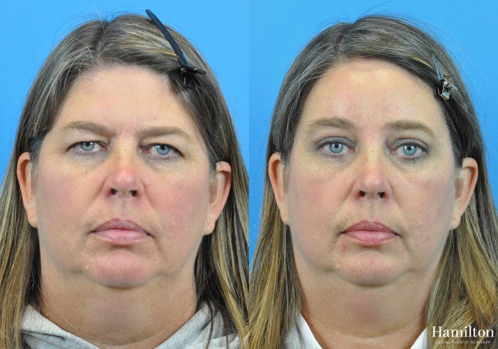 Before and after Brow Lift case 37209