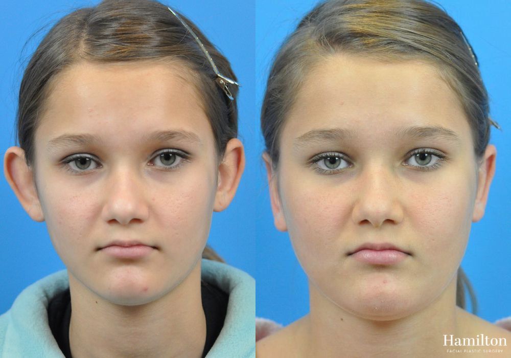 Before and after Otoplasty case 37149