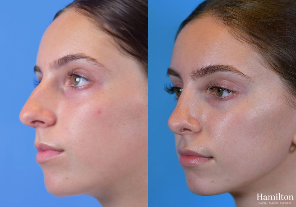 Before and after Rhinoplasty case 37198 - Angle 2