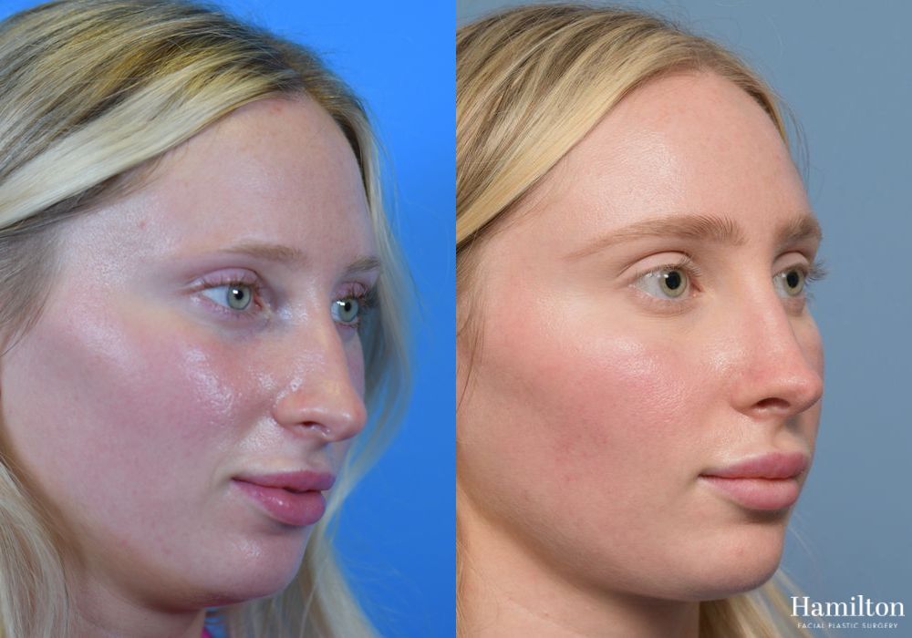 Before and after Rhinoplasty case 37157 - Angle 2