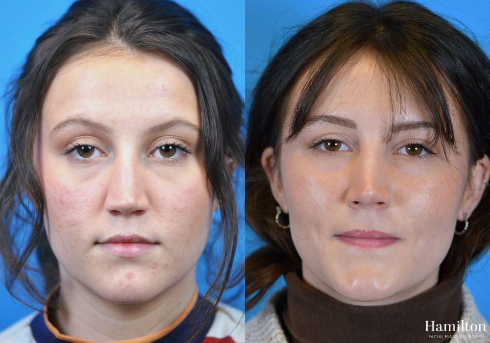 Before and after Rhinoplasty case 37275 - Angle 5