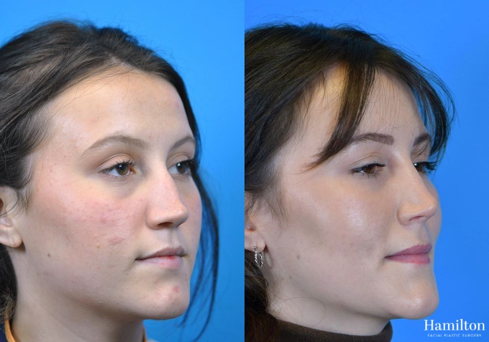 Before and after Rhinoplasty case 37275 - Angle 2